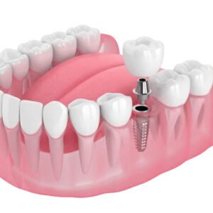 exemplo de dente fixo - implante unitário