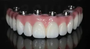 prótese protocolo, dente fixo, dentadura, betim