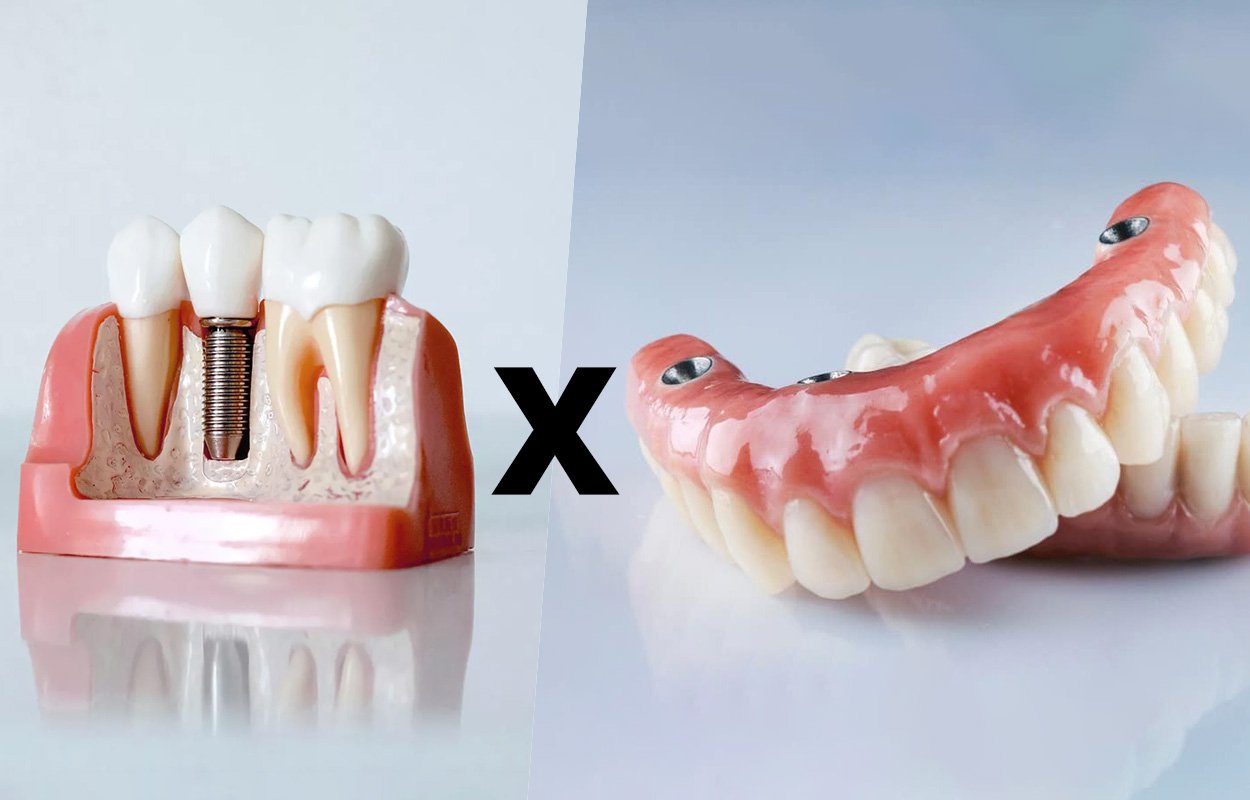 Qual a diferença entre dente fixo (implante unitário) e Prótese Protocolo?