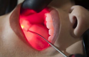Tratamento a Laser em Odontologia: Parestesia, Hipersensibilidade e Cuidado Oncológico em Betim